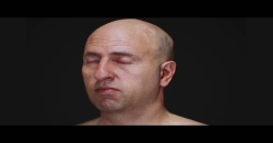 Rinoplasti